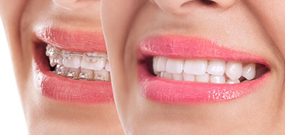 The image shows a close-up of a person s smiling face with a focus on their teeth, which are enhanced by braces, and lips painted with pink lipstick.