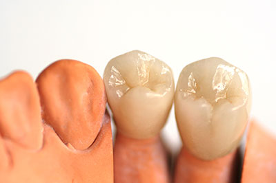 The image shows a close-up view of three artificial teeth with visible dental implant components, placed side by side against a neutral background.