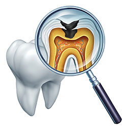 The image displays a magnified view of a tooth with an X-ray on top, showing internal dental structure including roots, pulp chamber, and dentin layers, with a focus on a cavity, and a pair of tweezers pointing towards the tooth, suggesting a dental examination or procedure.