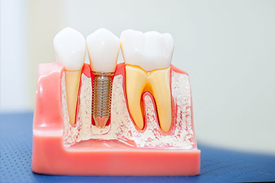 The image shows a dental model with several teeth and gums, featuring artificial tooth roots and crowns, alongside a small screw-like object that appears to be an implant fixture.