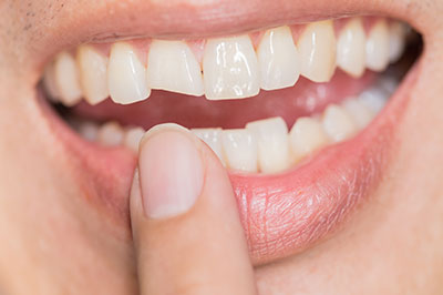 The image shows a person holding their finger near their mouth with a smile, displaying a white dental implant.