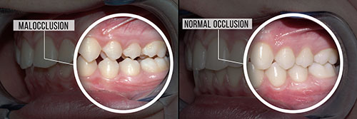 The image shows before-and-after views of a person s teeth with a focus on dental malocclusion, highlighting the transformation from an unaligned state to one with orthodontic correction.