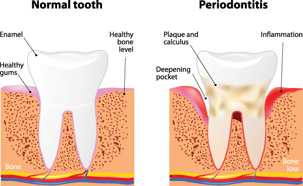 The image shows a diagrammatic illustration of a tooth with annotations explaining different stages of dental decay, from normal to advanced periodontitis, highlighting the progression of cavities and bone loss around the teeth.