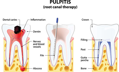 The image displays a diagrammatic representation of a dental pulpitis process, illustrating inflammation, dental caries, infection, and the progression of the condition from crown to root canal therapy, with annotations indicating different stages and components of the tooth.