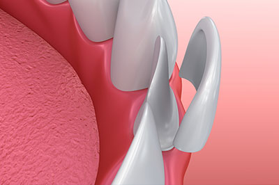 The image shows a close-up view of a dental implant with a visible screw, set against a pink background resembling gum tissue.