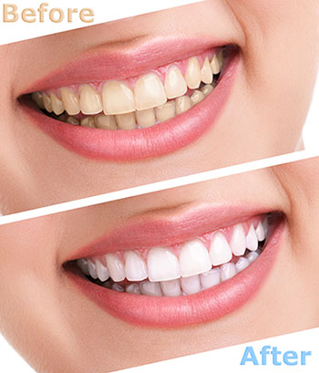 The image shows a before-and-after comparison of a person s teeth after dental treatment, with the  before  showing yellowed teeth and the  after  revealing clean, white teeth.