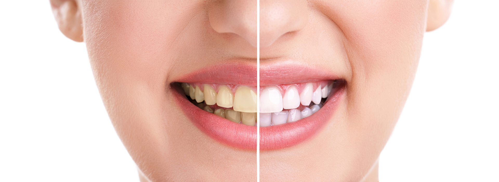 The image shows a close-up of a smiling person with teeth whitening product applied, highlighting the transformation process.