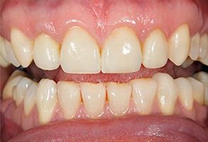 The image shows a close-up view of a person s teeth with a focus on yellowing and staining, highlighting dental health concerns.