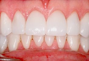The image shows a close-up of a person s teeth with a focus on their alignment and condition, likely for dental care or cosmetic purposes.