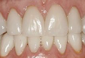 The image shows a close-up view of a person s teeth with a focus on a large gap between the front teeth, which appears to be a dental issue requiring attention.